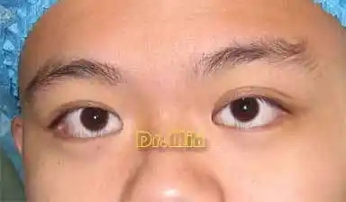 先天性眼睑退缩并内翻倒睫的矫正 - 好大夫在线