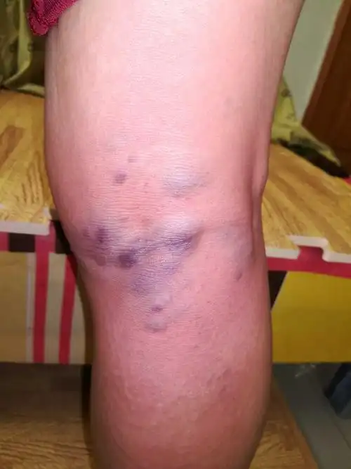 血毒皮肤病脓疮