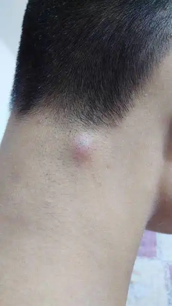 还疼,今晚上破了流的是黄色东西,,问问这是什么包,是火疖子还是毛囊炎