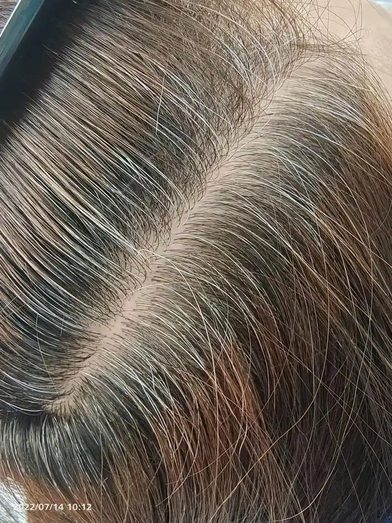 这是治白发的效果,照片下有日期,这个姐是7.1号来的,从白转 - 抖音