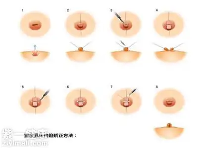 乳头内陷怎么样矫正在青春期矫正最佳