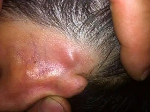 这二天耳朵上长了个东东,硬硬的,谁知道这是什么吗?