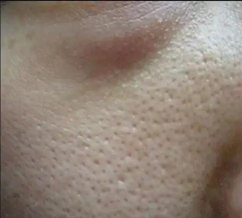 毛孔粗大的原因是什么