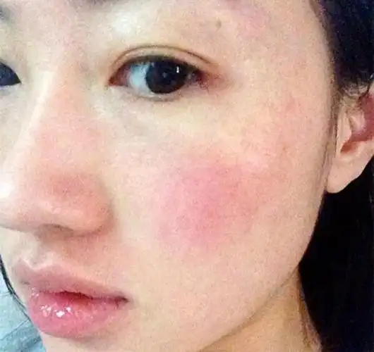 敏感皮肤经常泛红长痘,在选择洁面产品的时候要谨慎_凤凰网时尚_凤凰