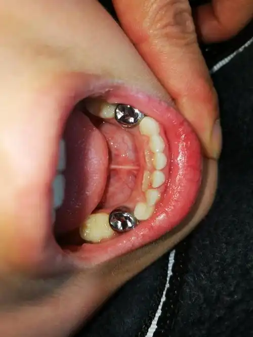 孩子长出电影中"异形"般的双排牙齿,家长惊慌:莫非宝宝是超人