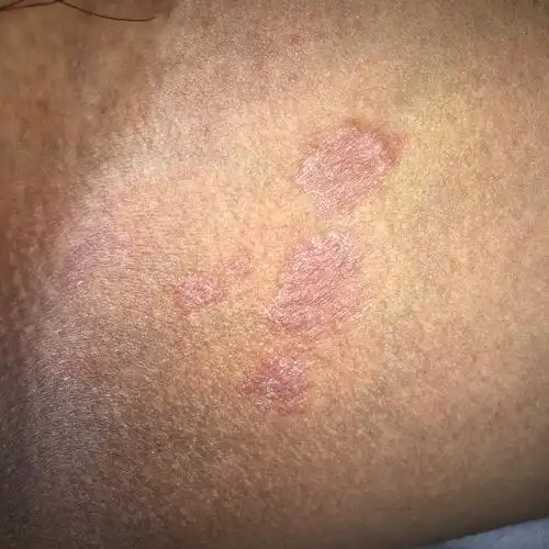 男,26岁,最近1个月左右 两个大腿根内侧各有一小片图片上的红色皮肤病