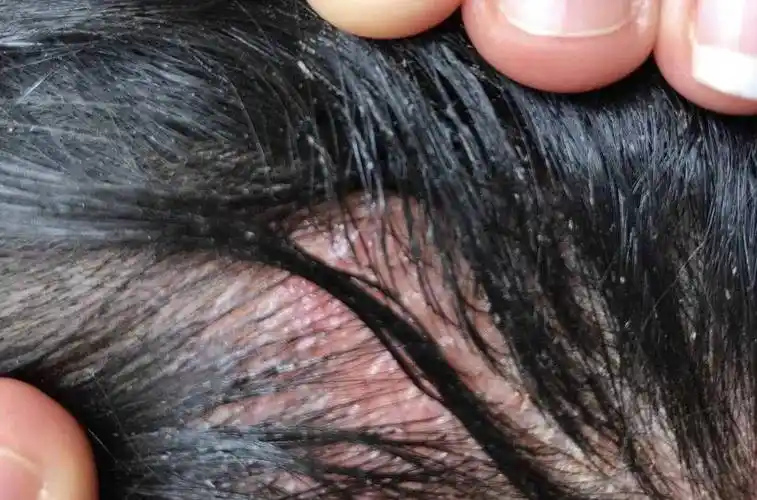 头皮很痒是怎么回事头皮巨痒什么情况