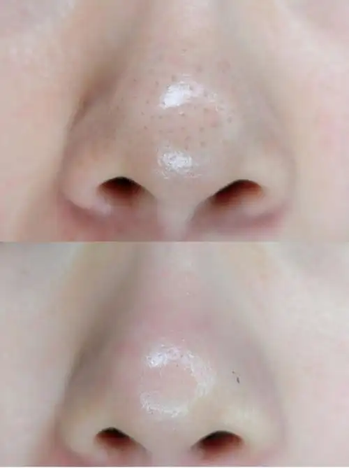 有没有去黑头比较靠谱的黑头贴呀. - 知乎