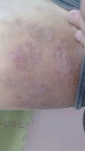 大腿两侧很痒,有水泡,夏天很严重,冬天会好些.