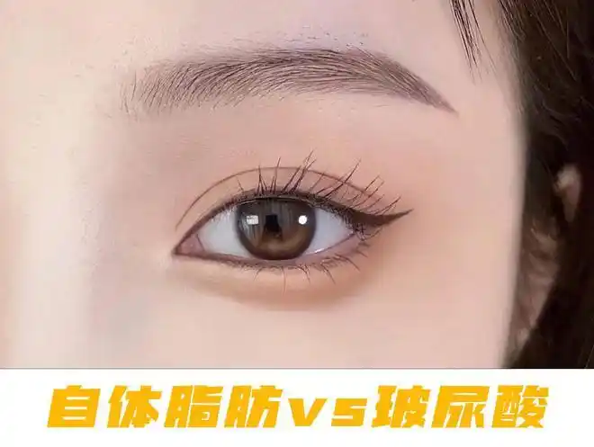 卧蚕填充选玻尿酸好还是自体脂肪好