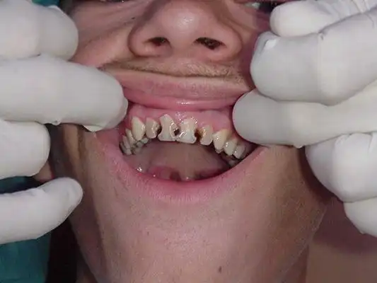 虫牙真实图片71