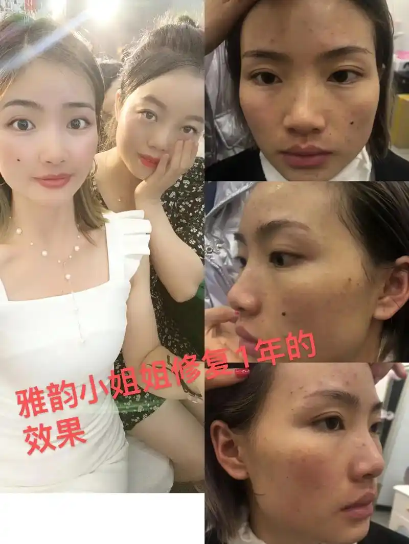 雅韵前后对比图#问题性皮肤管理 #雅韵国际 #告别肌肤问题  - 抖音