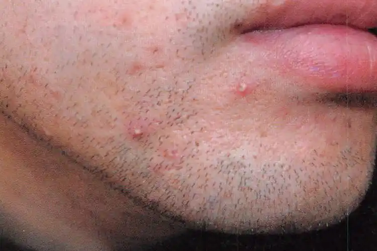 脸部毛囊炎的症状和图片