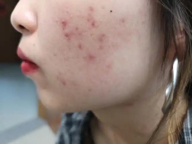 容易消灭的痘痘