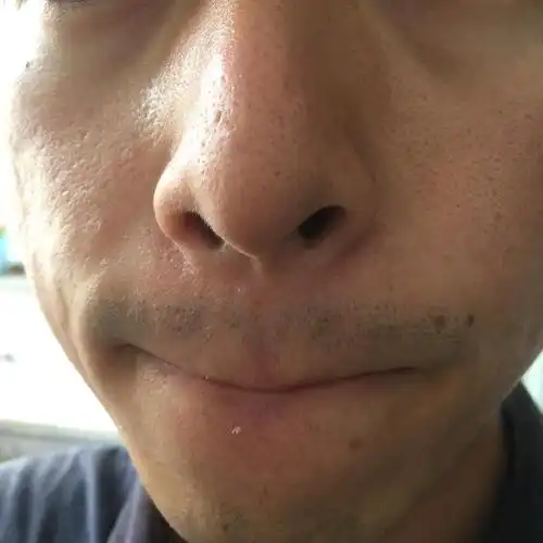 另外我这三角区的毛孔明显粗大,怎么办?