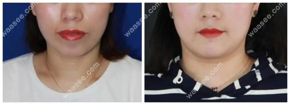 晒下我38岁牙齿骨性前凸戴隐适美牙套矫正前后脸型对比照