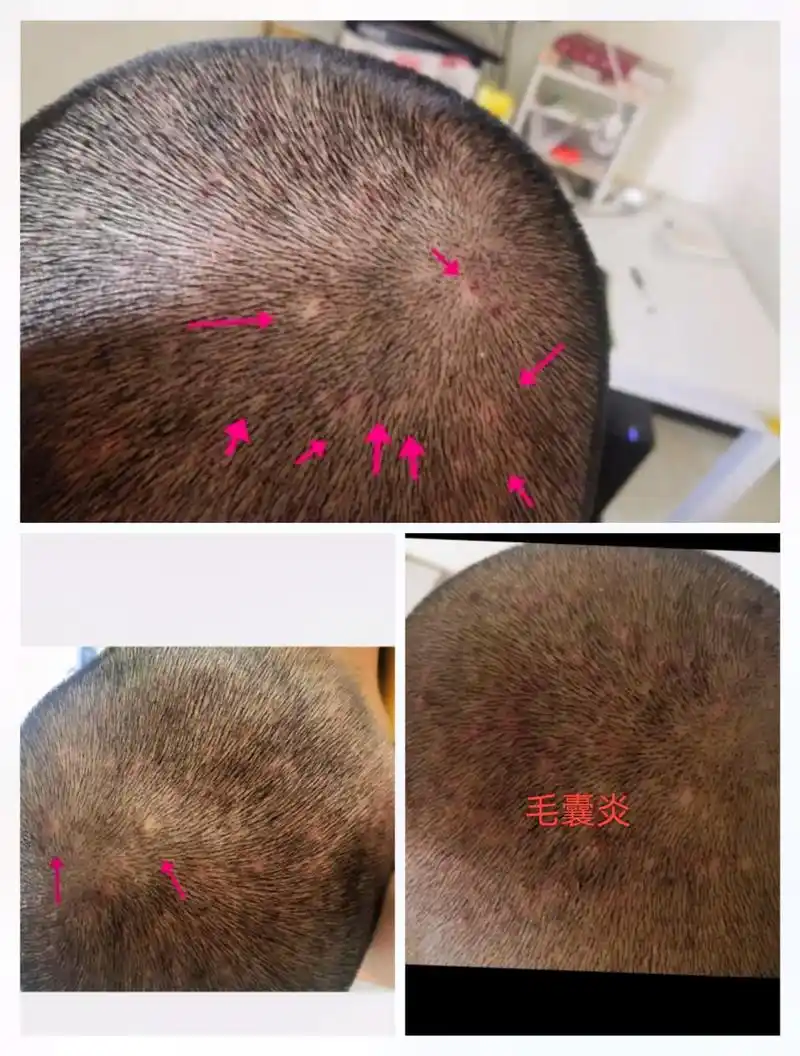 毛囊炎表现为毛囊性小结节,顶端有小脓疱;痤疮表现为丘 - 抖音