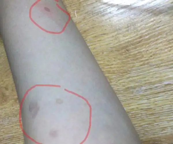 手臂上长了褐色的斑点