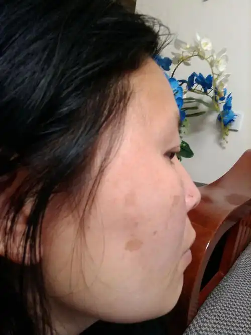 分享到:  2015-06-15 17:13 网友采纳 你这不止是斑的问题,皮肤还很