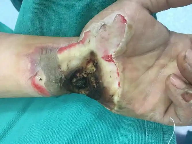 手腕电击伤 股前外侧游离皮瓣移植术-崔正军主任医师-爱问医生