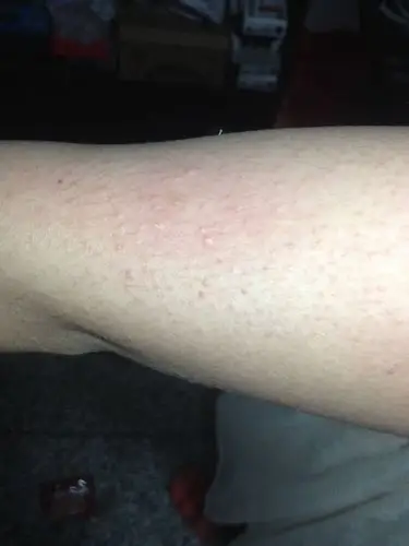 皮肤过敏问题,夏天一到,胳膊上就会起类似粉刺一样的小疙瘩,可以挤出