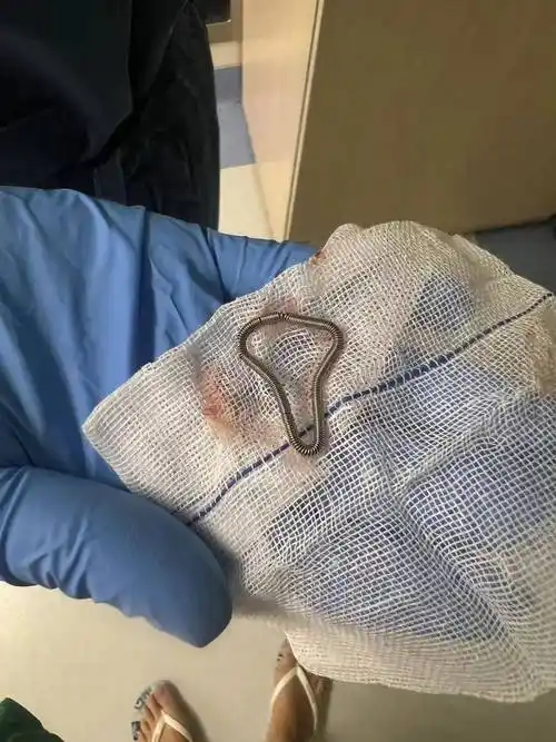 时隔29年,我陪妈妈去取出了"超龄"的节育环