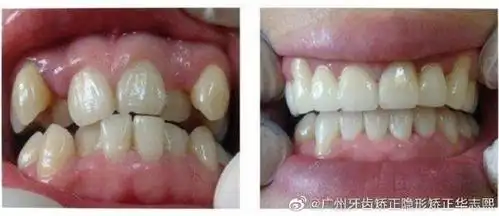 虎牙也叫犬齿,特别容易长    展开全文 c