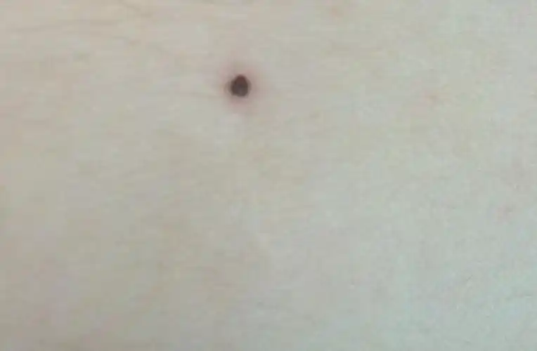 希望专业的人来看一下,最近小腿上一颗痣有时会发痒,挠过后就变成了