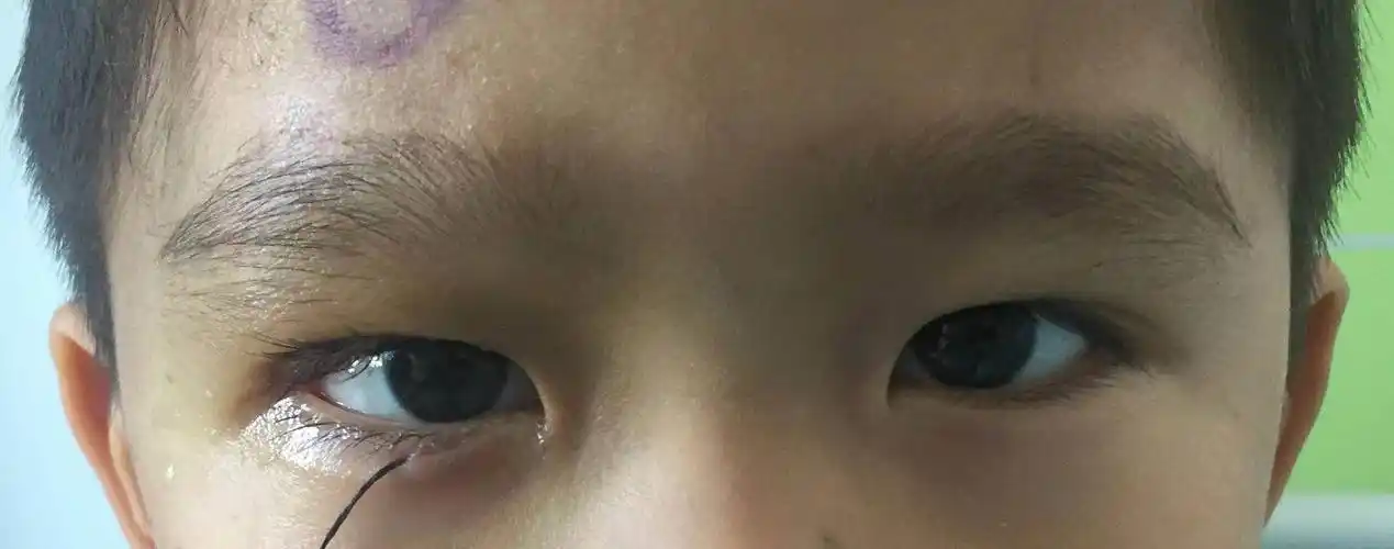 出生不久就确诊出上睑下垂3岁孩子全麻下被推进手术室