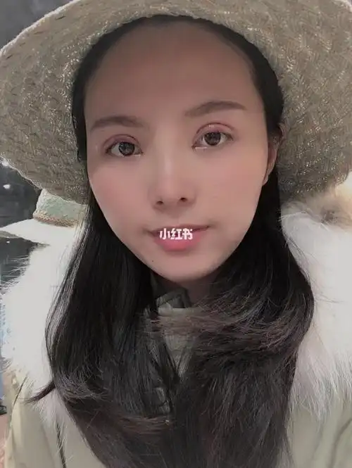 全切双眼皮眼综合术后第一天_双眼皮手术_美妆_医美整形