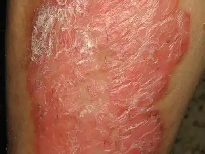 皮肤癣为何反复复发,久治不愈_成都银康银屑病医院