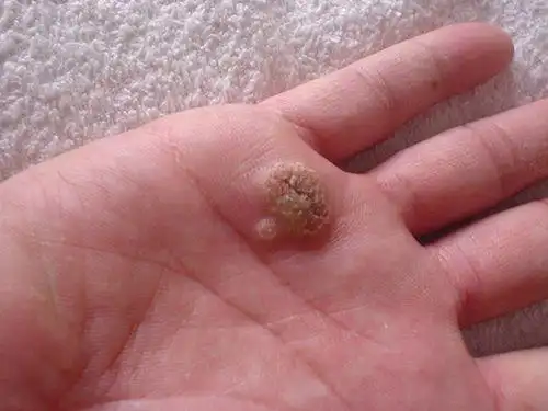 寻常疣怎么治好的快