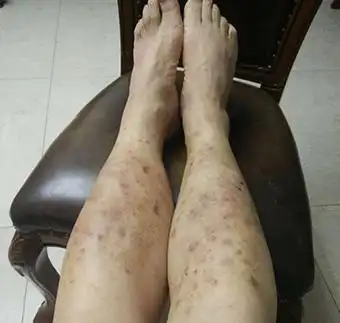 腿部湿疹症状及病因