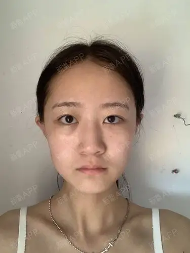 看一下术前,鼻翼是比较宽的,然后整个鼻头我非常讨厌,现在这个