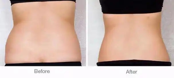 抽脂的危害和副作用(肚子抽脂的危害和副作用)