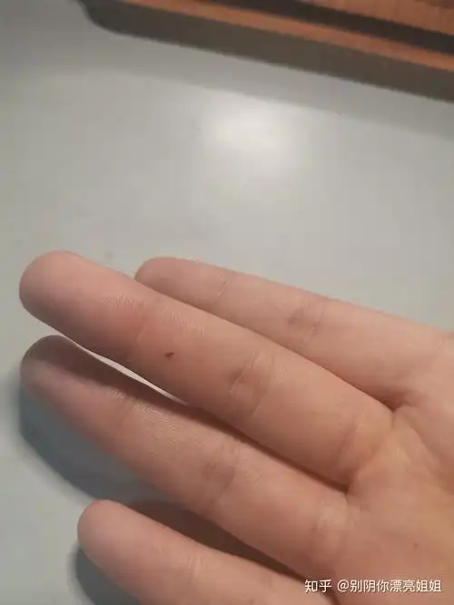 女生右手中指突然长了个小痣代表什麼? - 知乎