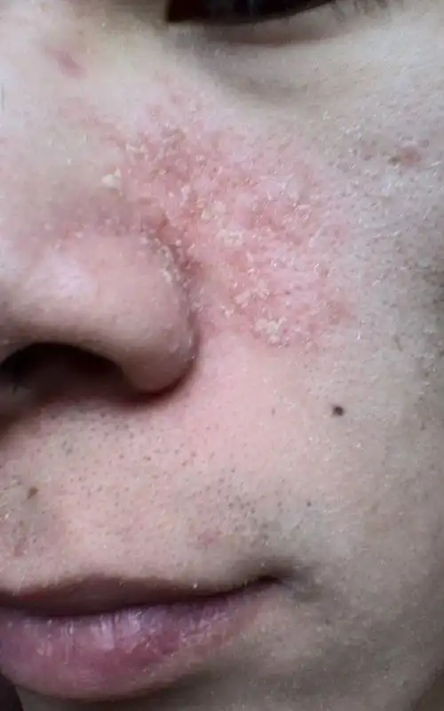 这是脂溢性皮炎吗?刚洗完脸,双颊的有刺痛