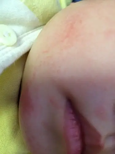 2016-02-05 23:11 一岁之前最号不要给宝宝吃蛋白,蛋白容易过敏,是