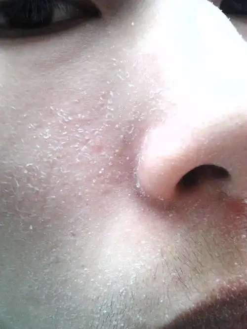 有问必答网 皮肤性病科 皮肤科 → 脸上脱皮一年四季都有这是什么毛病