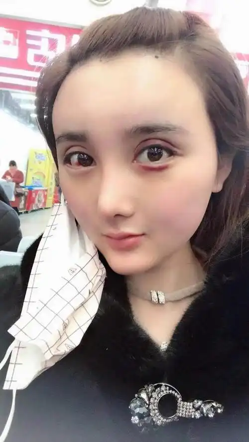 自体脂肪填充眼周注意事项,本篇告诉你