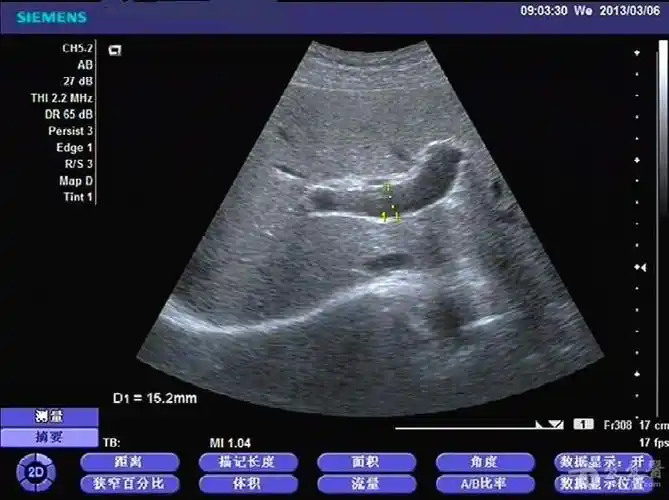 门静脉轻度扩张.