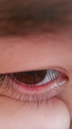 我的眼睛今早下眼睑内有个小白点,请问怎么回事,谢谢