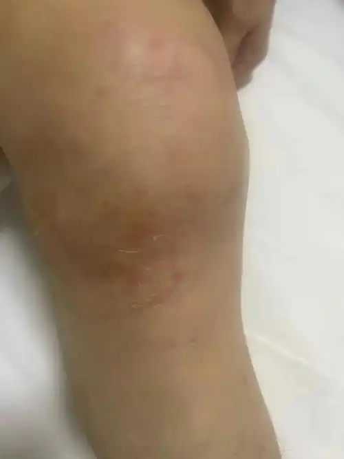 为什么总有人觉得膝盖积液越抽越多