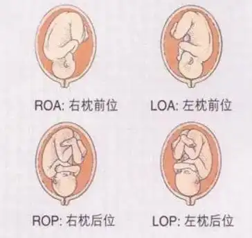 产检报告单loa胎位图是什么意思孕妇能顺产吗