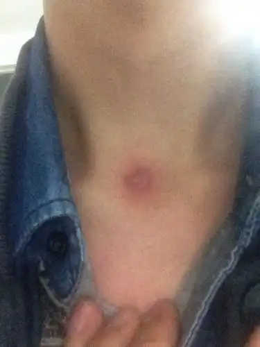 前几天胸口长了个火疖子,刚好,现在脖子正中间又长了个这个东西!