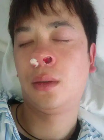 鼻窦炎症状图片 (44)