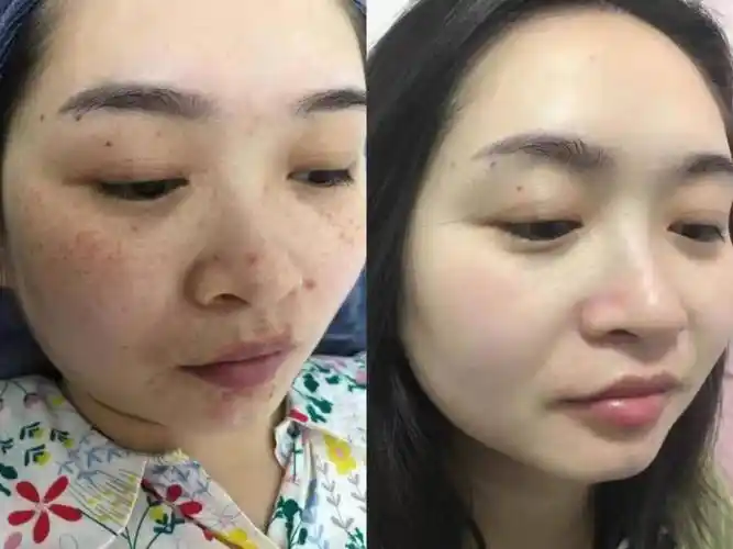 优选:祛斑排行榜第一名,值得信赖