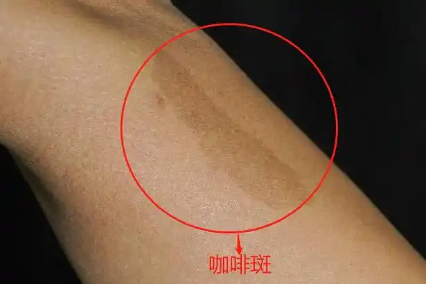 手臂上有咖啡色的斑图片