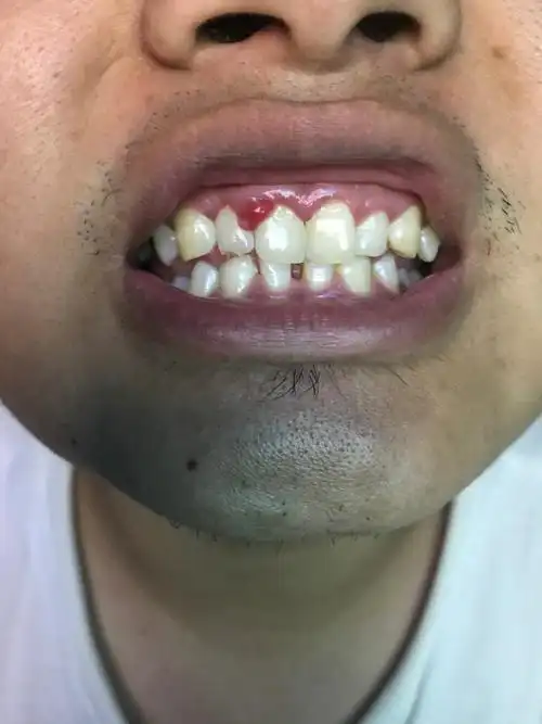 肉怎么回事 以前牙龈红肿一咬硬的水果就会出血,之后中间牙齿那的牙龈