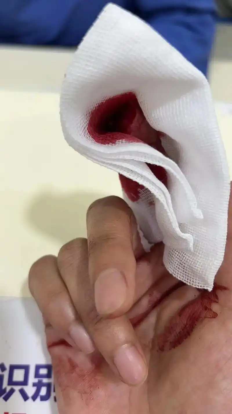 我可怜的大女儿手指夹掉一块肉买个皮缝上了我可怜的女儿啊. - 抖音